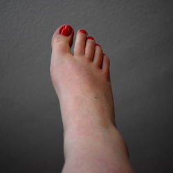 Toe-Nail Injury: Bella's Foot