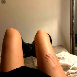 A Close-up Photograph of a Leg of a Person with a Mark on It