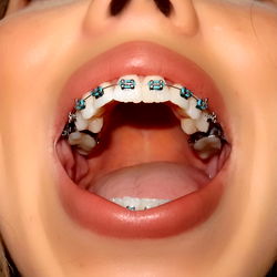 Kate in Braces: A Vivid Display of Teen Spirit