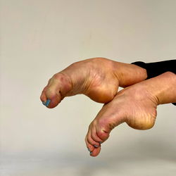 Elsa, a Los Angeles Based Model, Showcasing Her Foot Issues