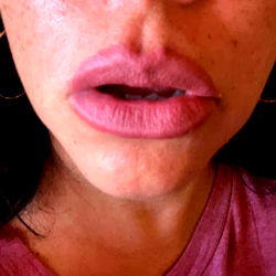 Sensual Lip Enhancement